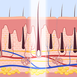 힐라이트 재생레이저
