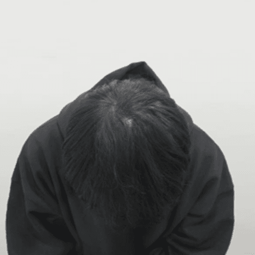 500모 이식 + 줄기세포 주사 10회차 중 3회 AFTER