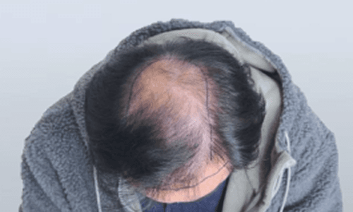 탈모 부위 예시 3