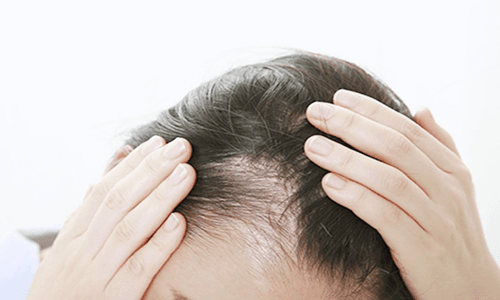 비절개 모발이식