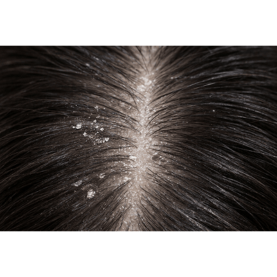 치료 전 두피 상태