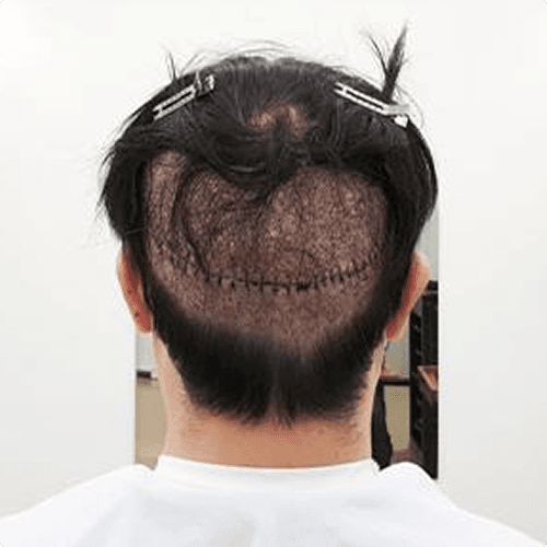 비절개 모발이식 사례 1
