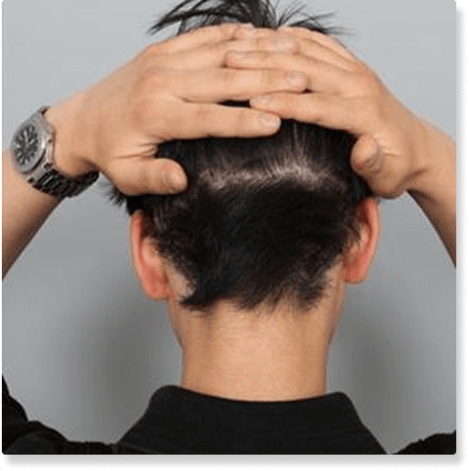 비절개 모발이식 사례 2